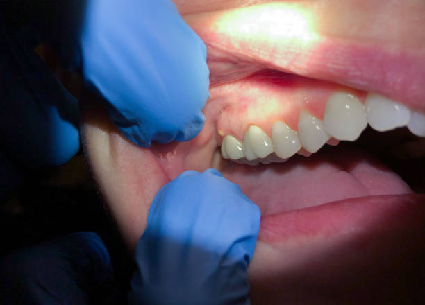Best Emergency Dentist for Knocked-Out Tooth in Carson, WA